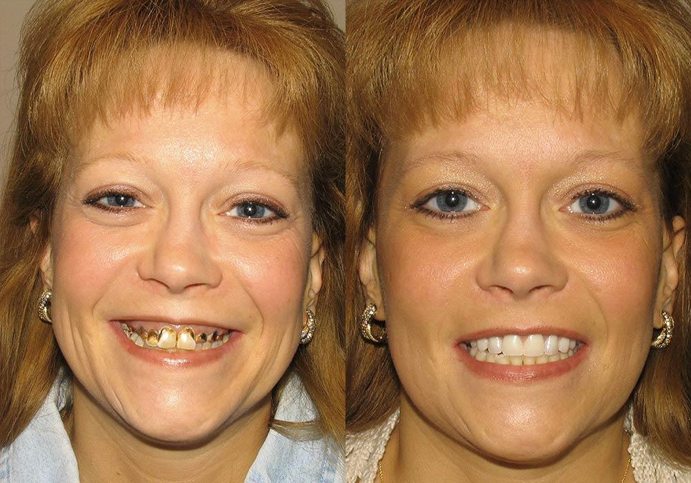 Dentures vs dental implants for missing teeth in Chennai