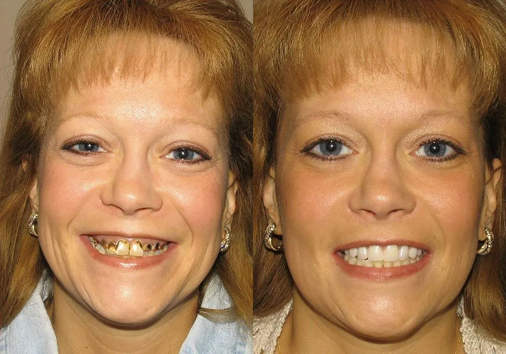 Dental Implant Cost in Chennai for Adults in Chennai