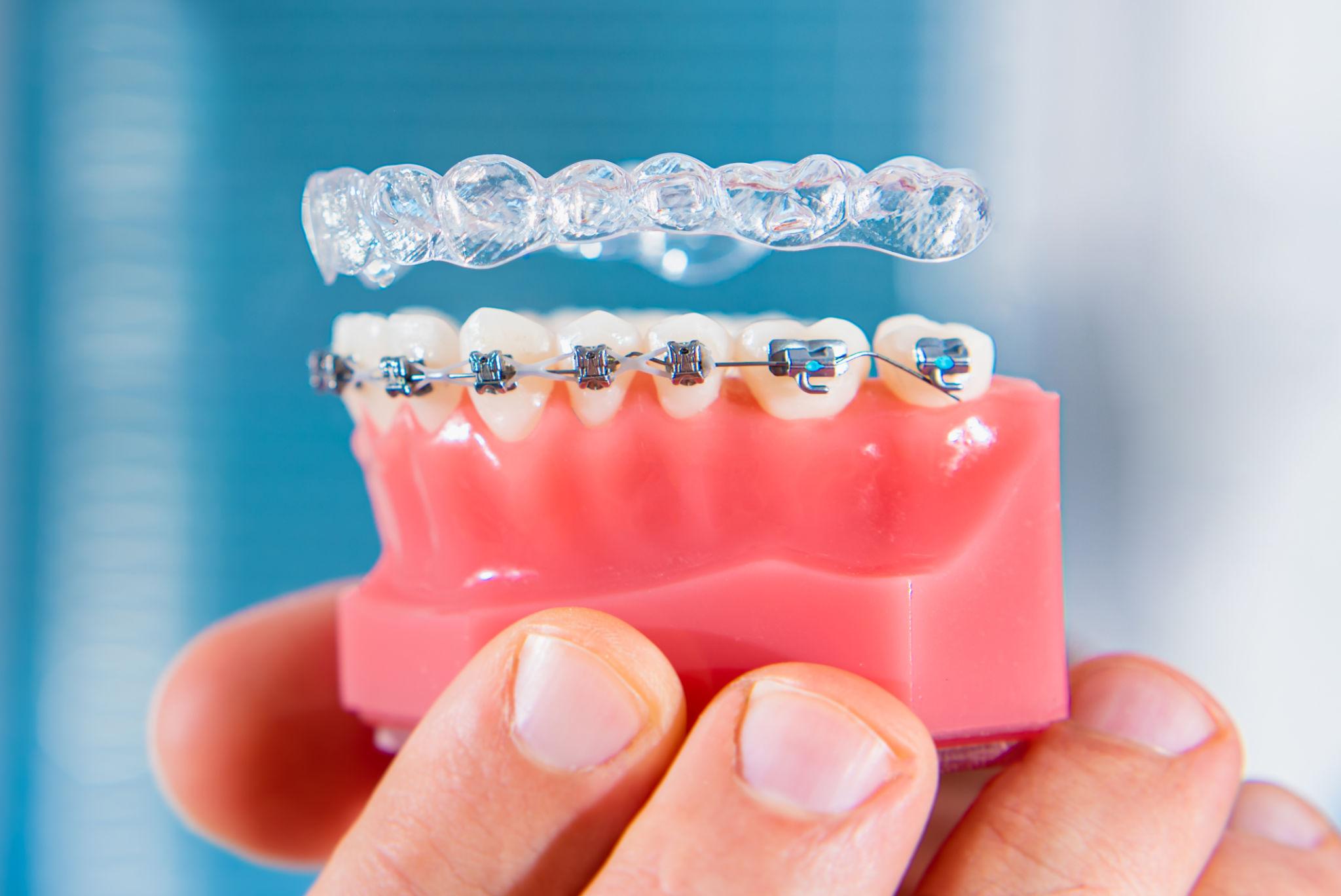 Braces and Invisalign comparison in Chennai