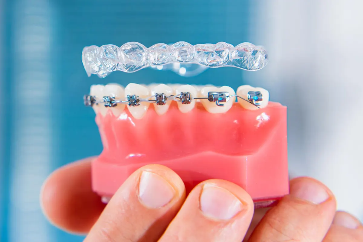 Invisalign Cost in Chennai in Chennai