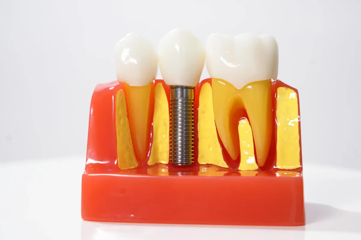 Dental Implant Cost in Chennai in Chennai