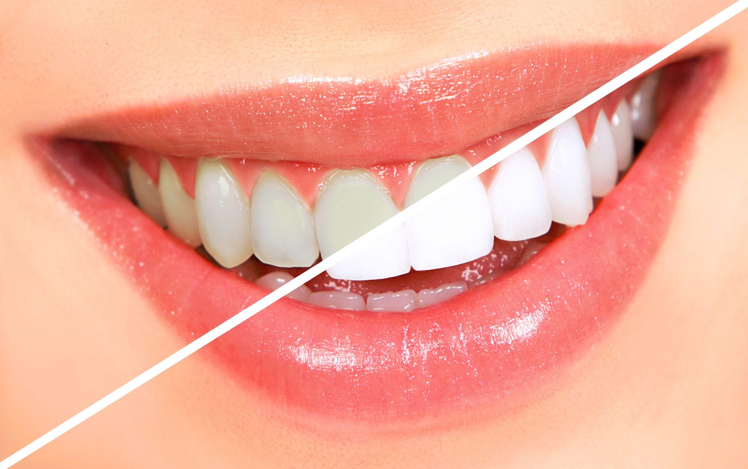 Teeth whitening in Chennai for a brighter smile