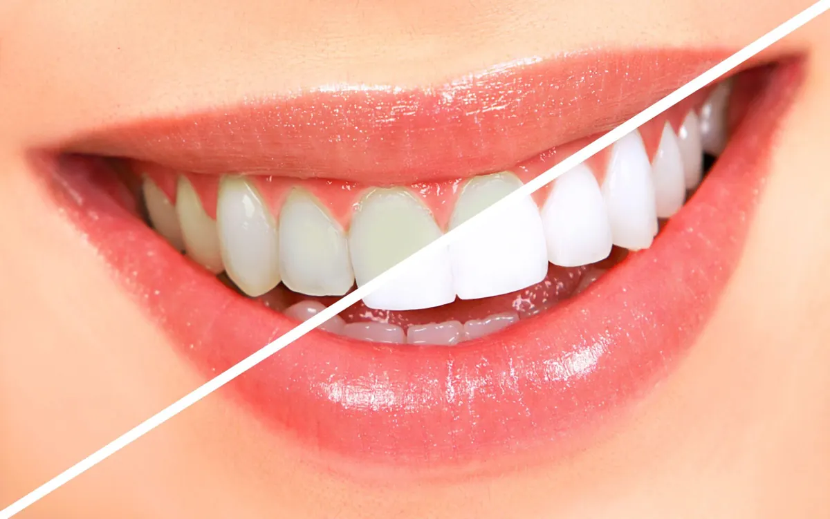 Teeth Whitening Cost in Chennai Before and After in Chennai